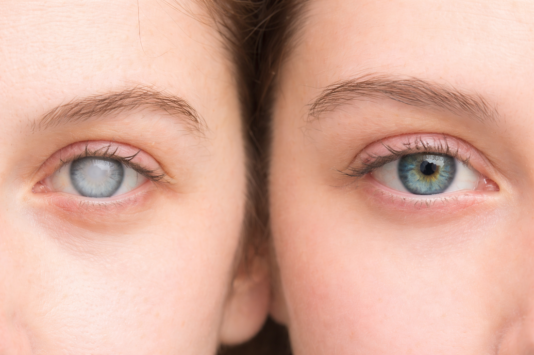 Cataracta și protecția UV – ce nu trebuie să ignori