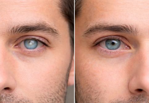 Cataractă și glaucom – Cele mai frecvente cauze ale pierderii vederii